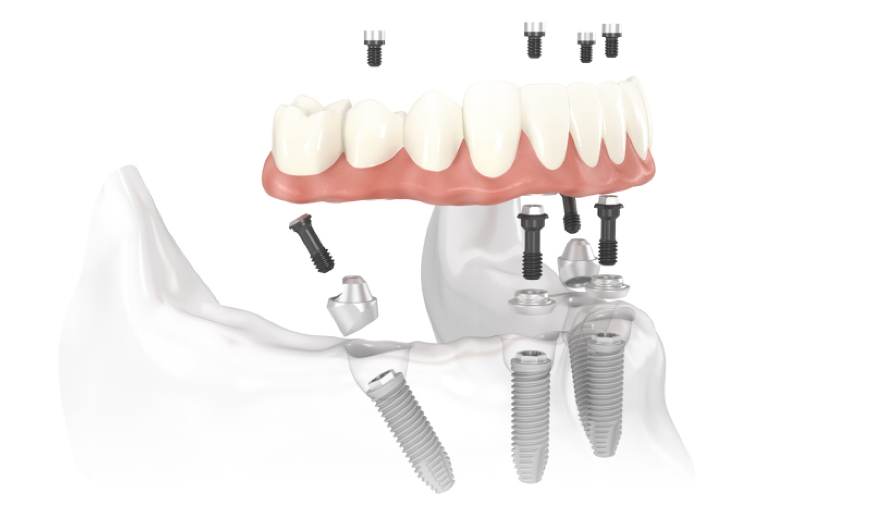 Le cabinet du Dr LACROIX est fier de vous présenter la solution « All-on »