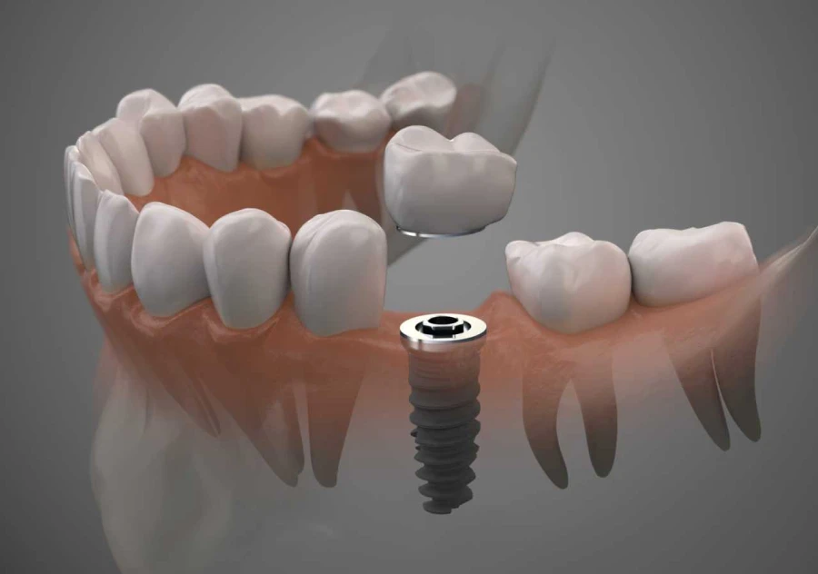 Implants unitaires ou multiples