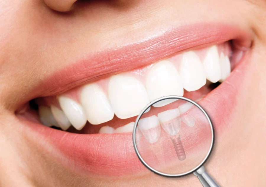 Extraction implantation immédiate