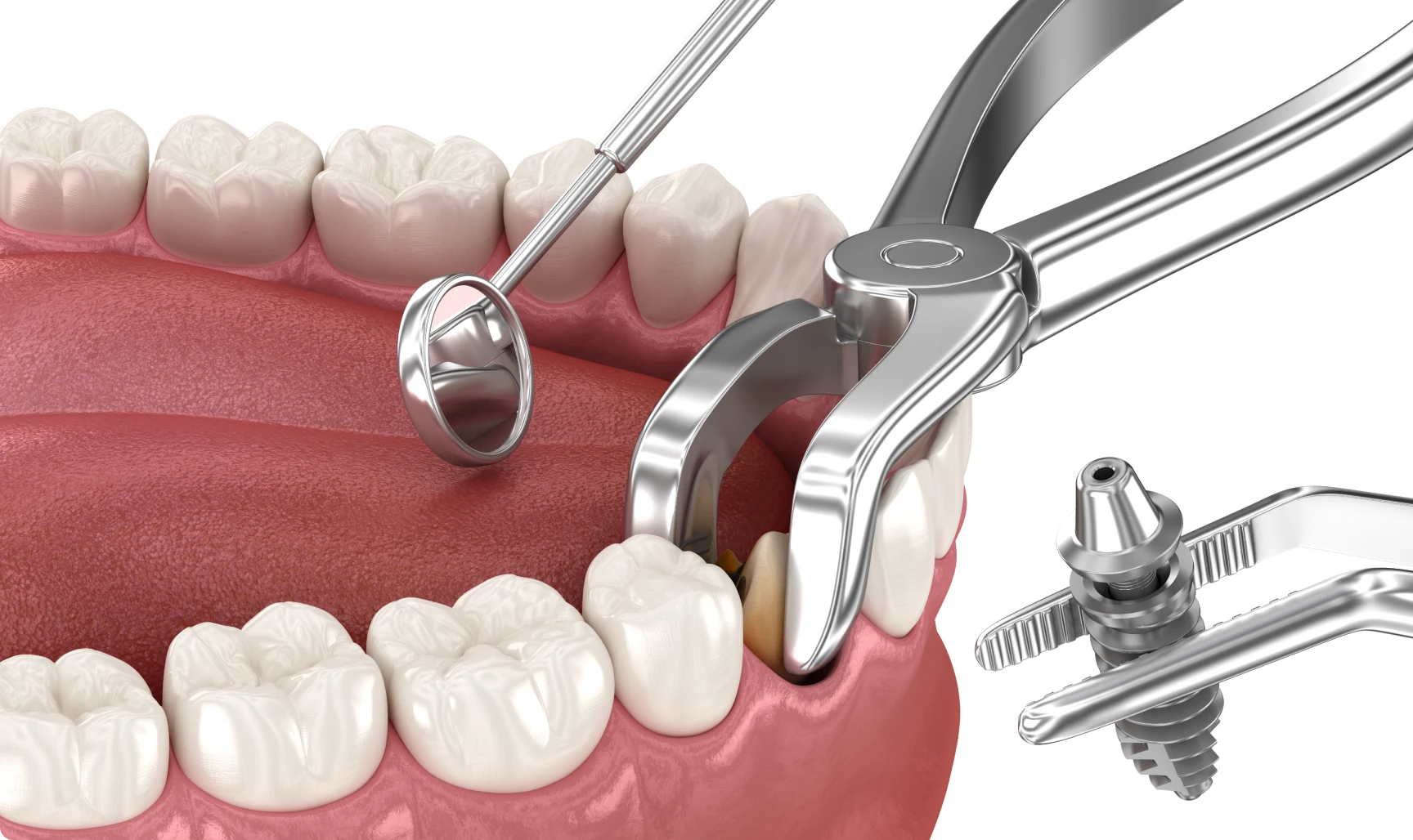 Extraction implantation immédiate à Grenoble 38000
