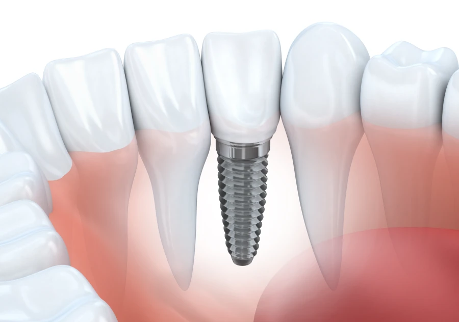 Implants unitaires ou multiples