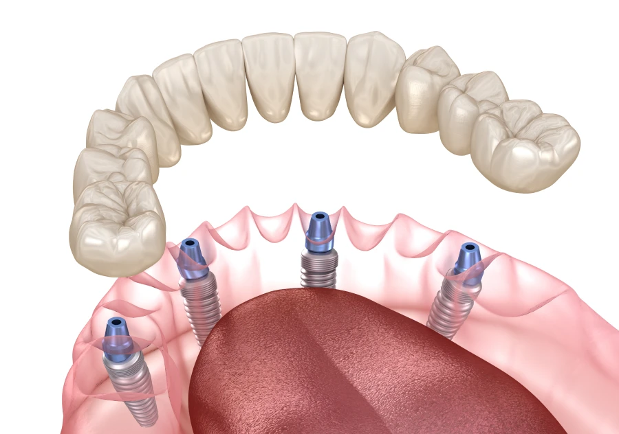 All-on-4 ou All-on-6