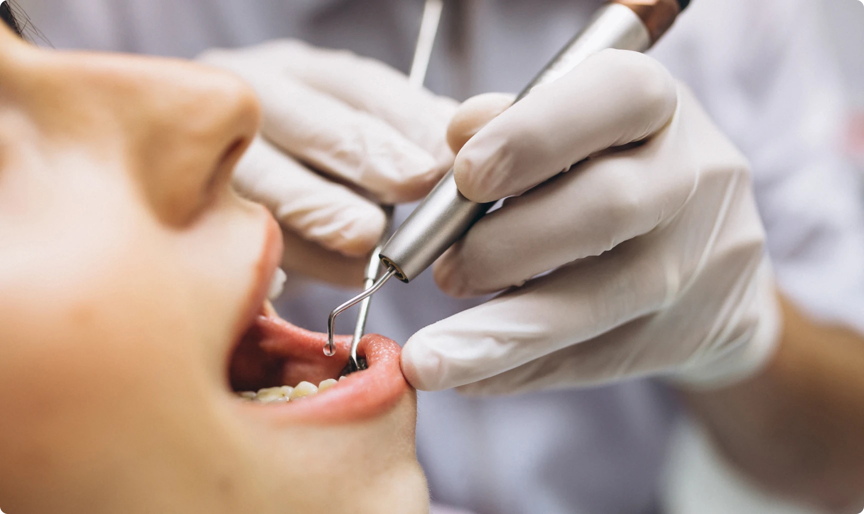 Les biopsies sont réalisées sous anesthésie locale pour minimiser l'inconfort.