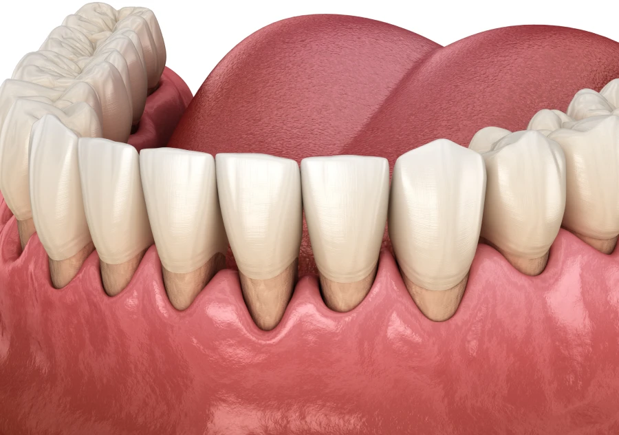 Correction de la récession gingivale