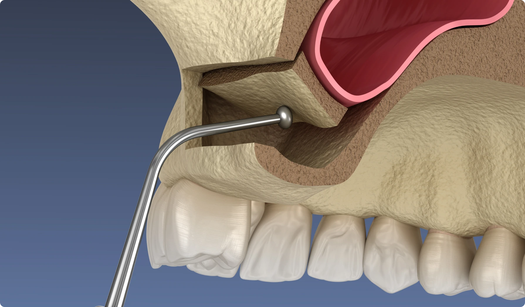 Traitement des fistules oro-sinusiennes à Grenoble 38000