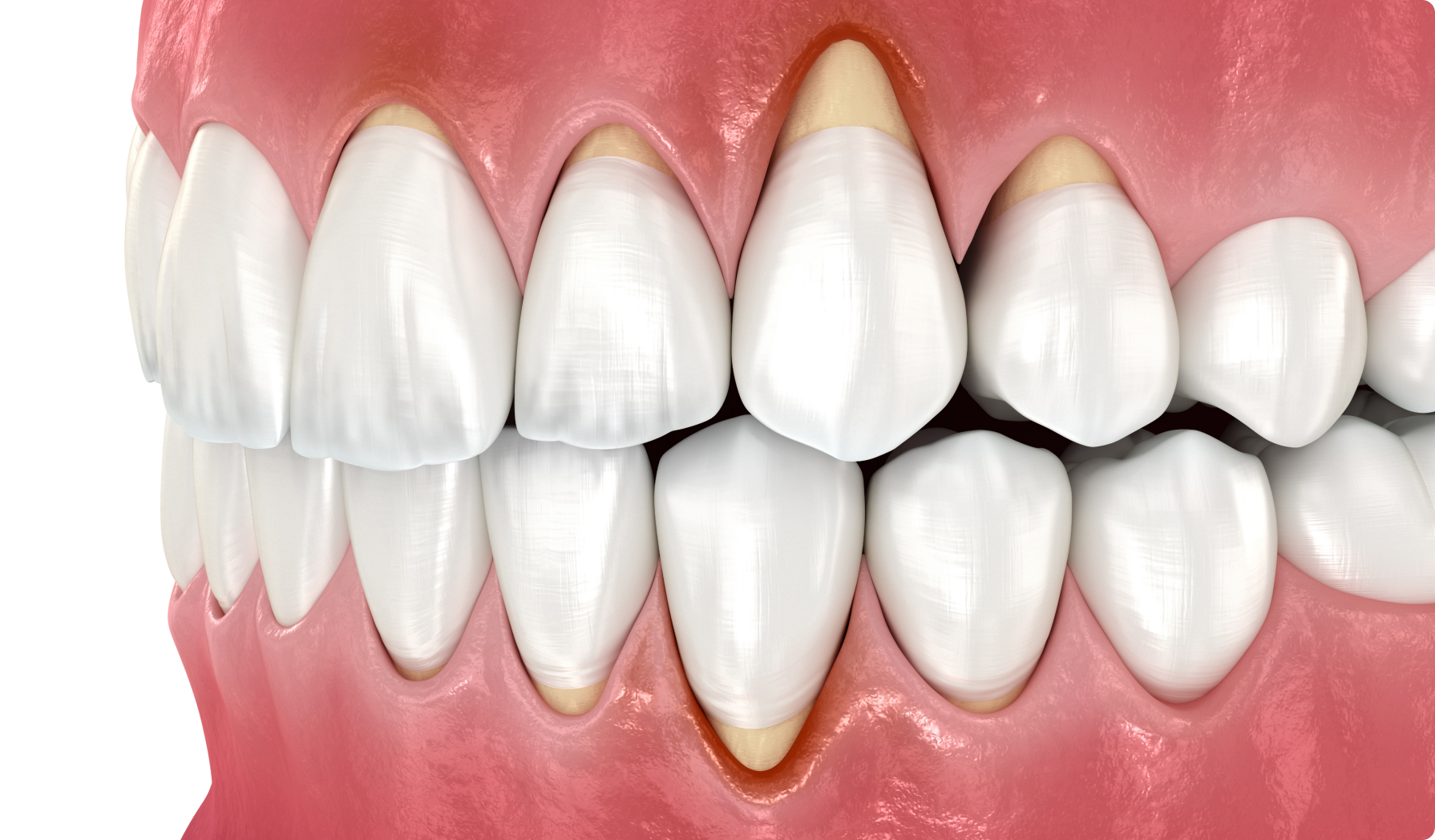 Si vous êtes préoccupé par la récession gingivale ou souhaitez en savoir plus sur la chirurgie gingivale, n'hésitez pas à nous contacter pour un rendez-vous.  