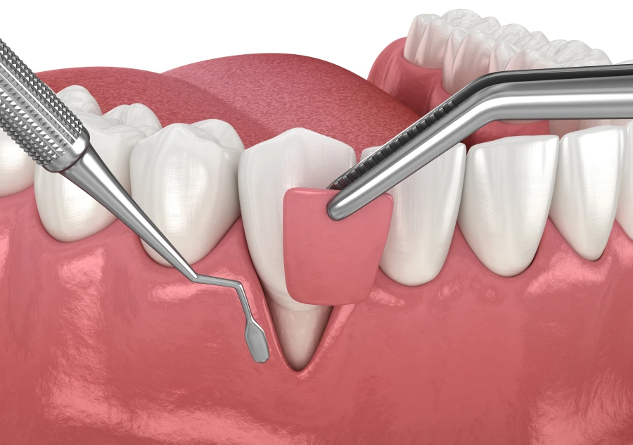 Correction de la récession gingivale