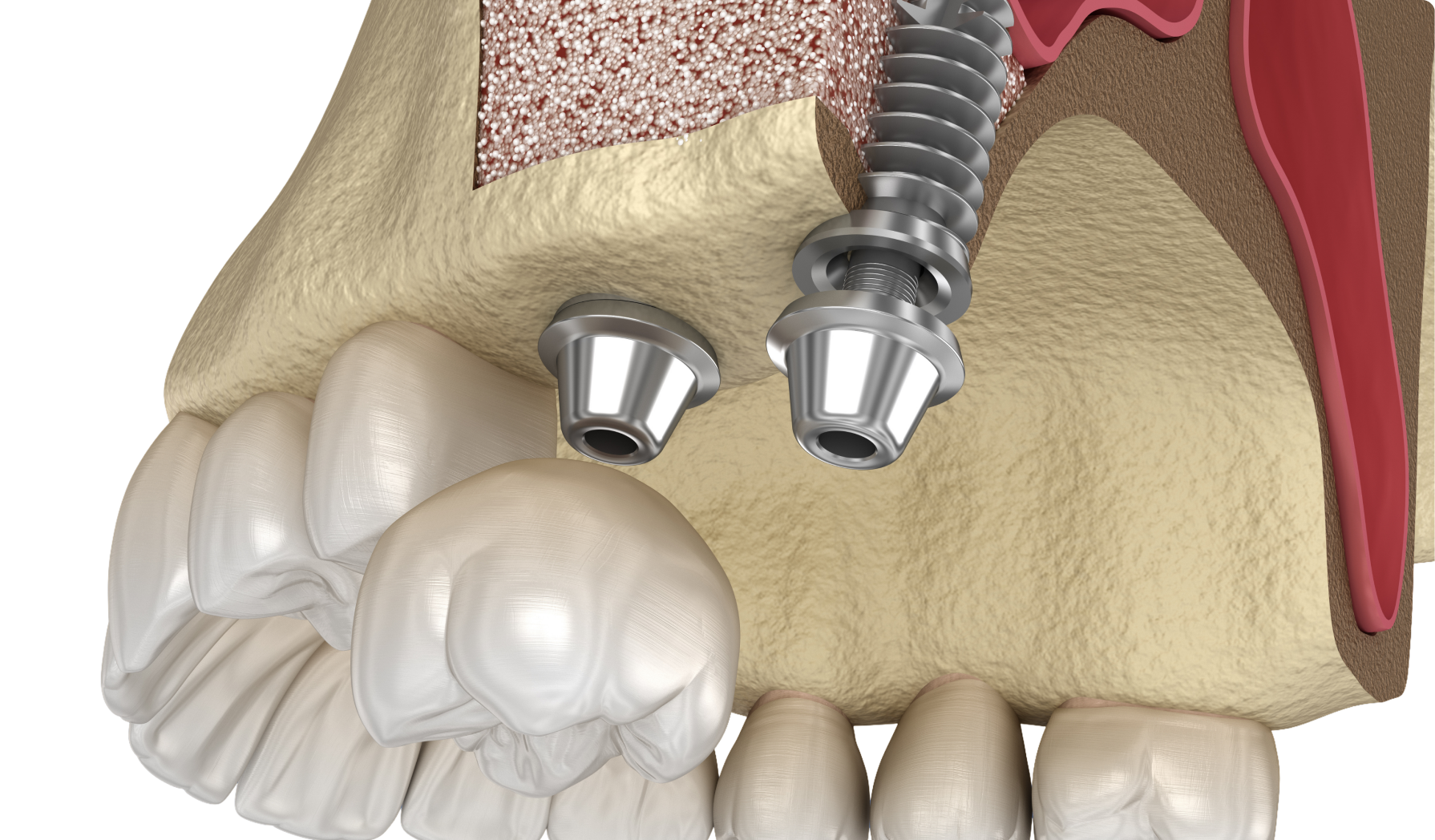 Pourquoi choisir notre cabinet de chirurgie pour votre soulevé de sinus ?