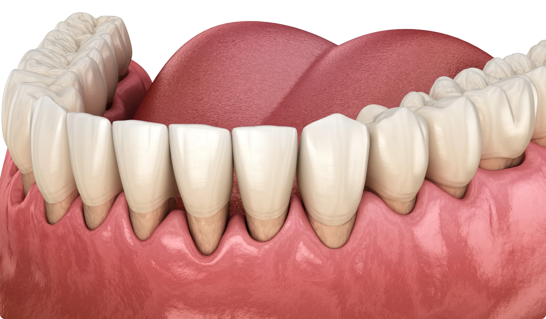Les greffes de gencives : restaurer votre sourire et protéger vos dents