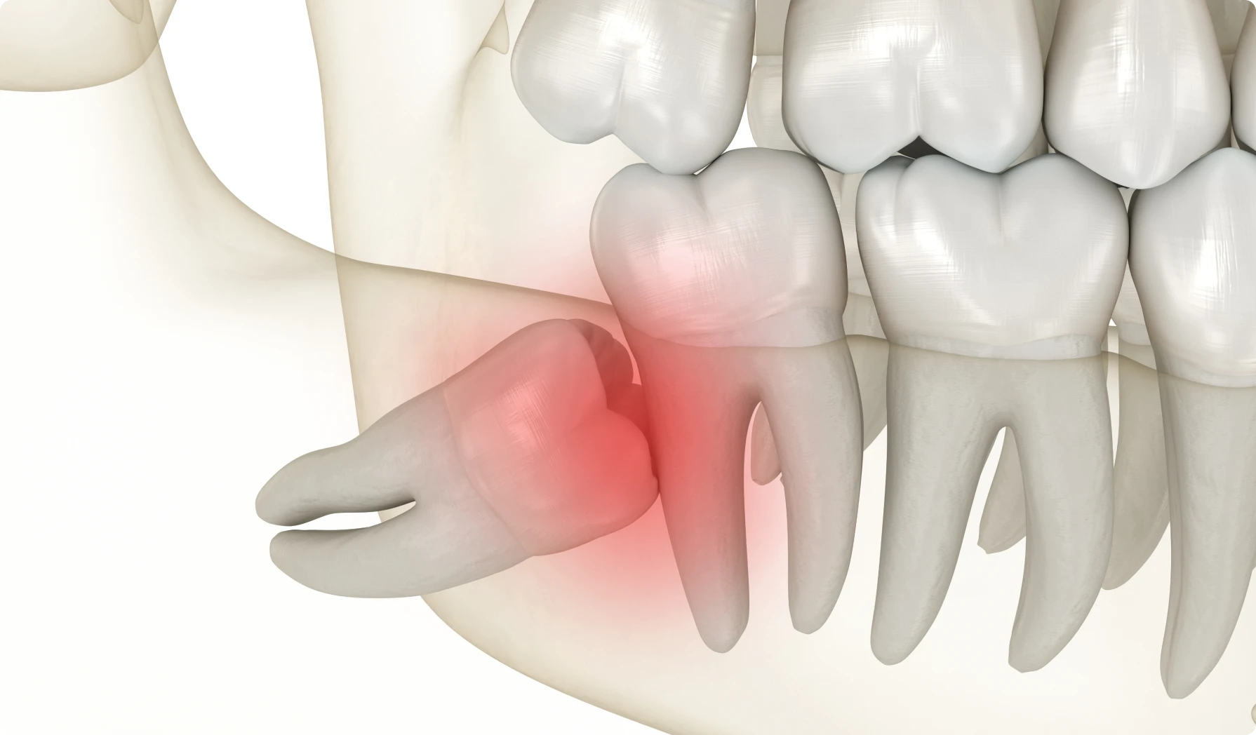 Questions fréquentes sur les dents de sagesse
