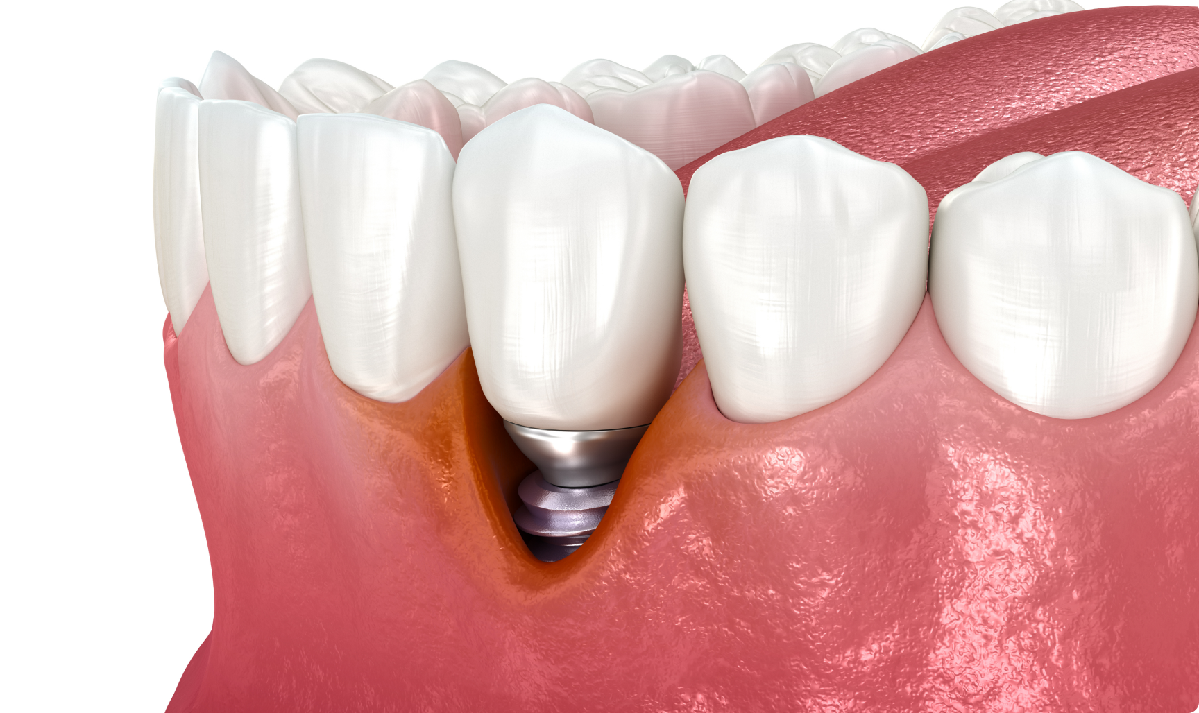 Le traitement de la péri-implantite vise à éliminer l'infection et à stabiliser la condition de l'implant.