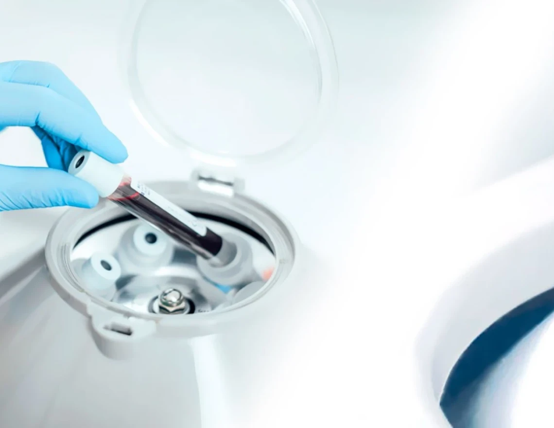 Dr Lacroix, chirurgien-dentiste Grenoble 38000 : Plasma Riche en Fibrine (PRF)