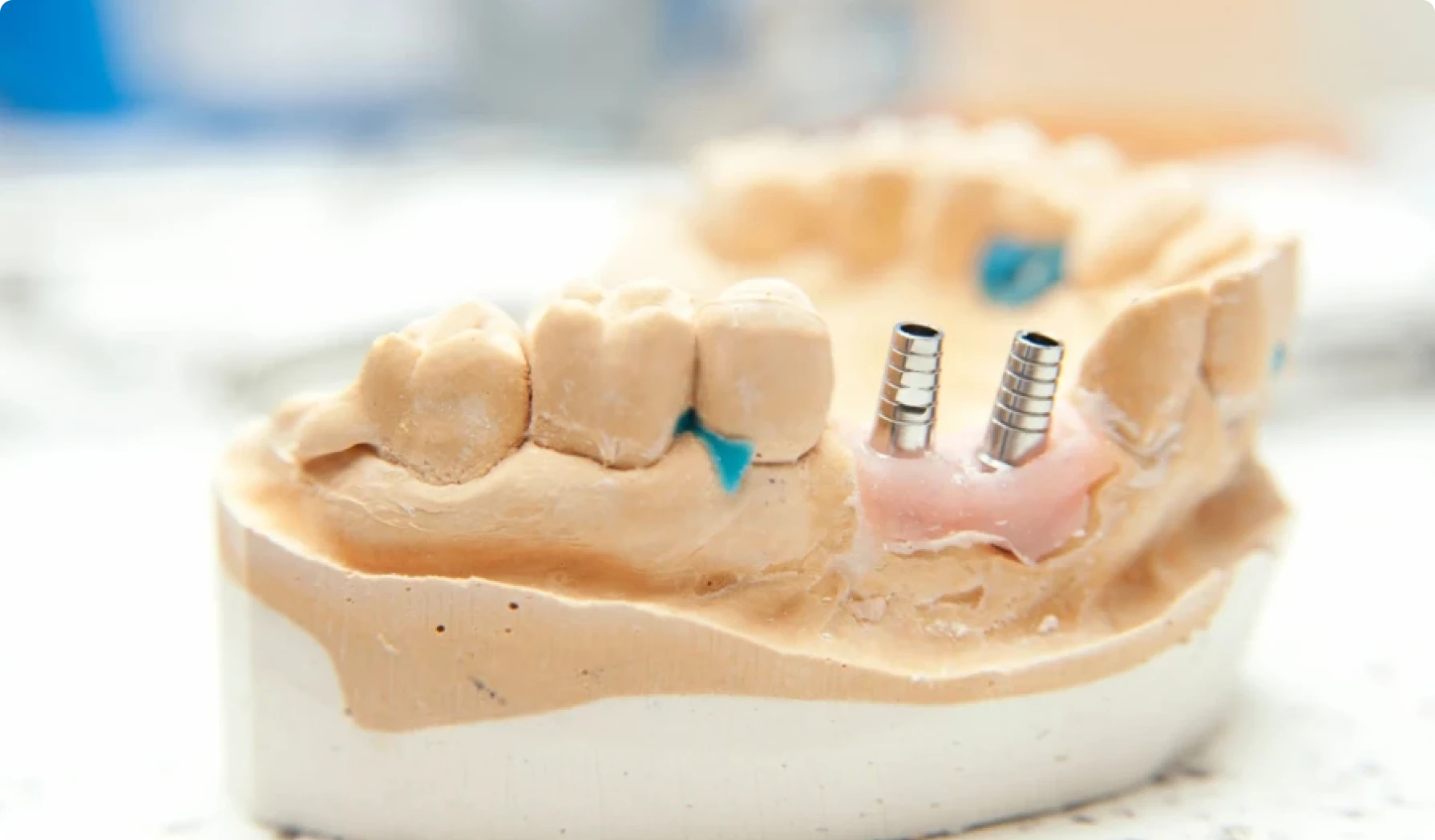La résorption osseuse après la perte des dents : comprendre, prévenir et traiter